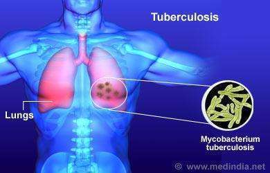 tuberculosis-tb