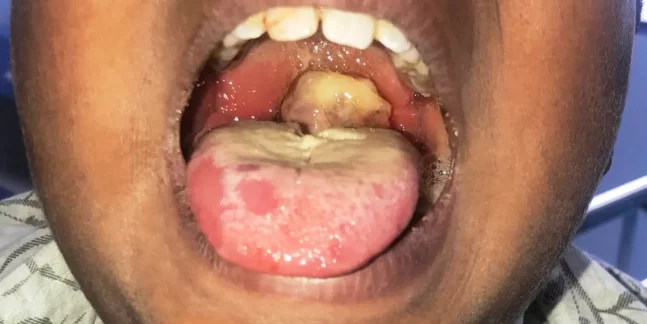 Diphtheria-outbreak-647x324