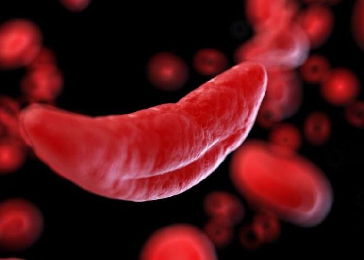 sickle_cell_1200x900-750x536