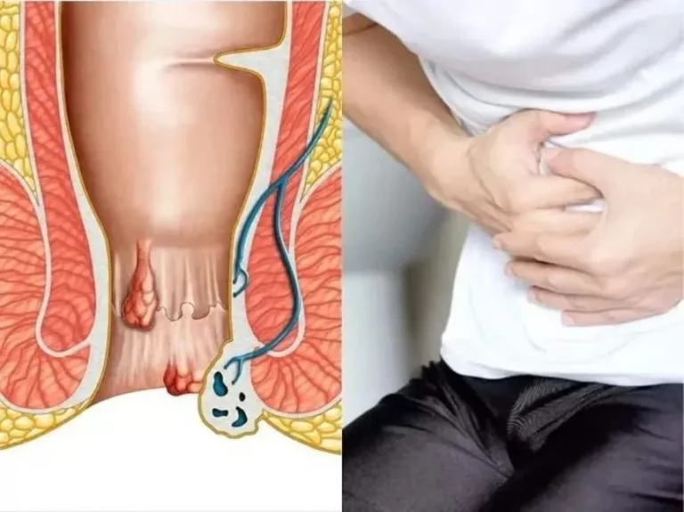 haemorrhoids1-860x644.jpg