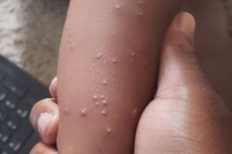 scabies-ad2584a-1